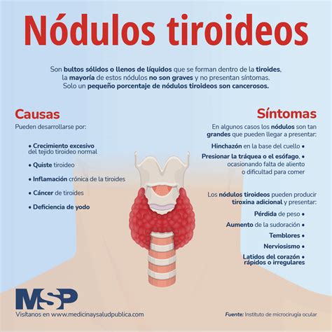 nódulo tiroideo